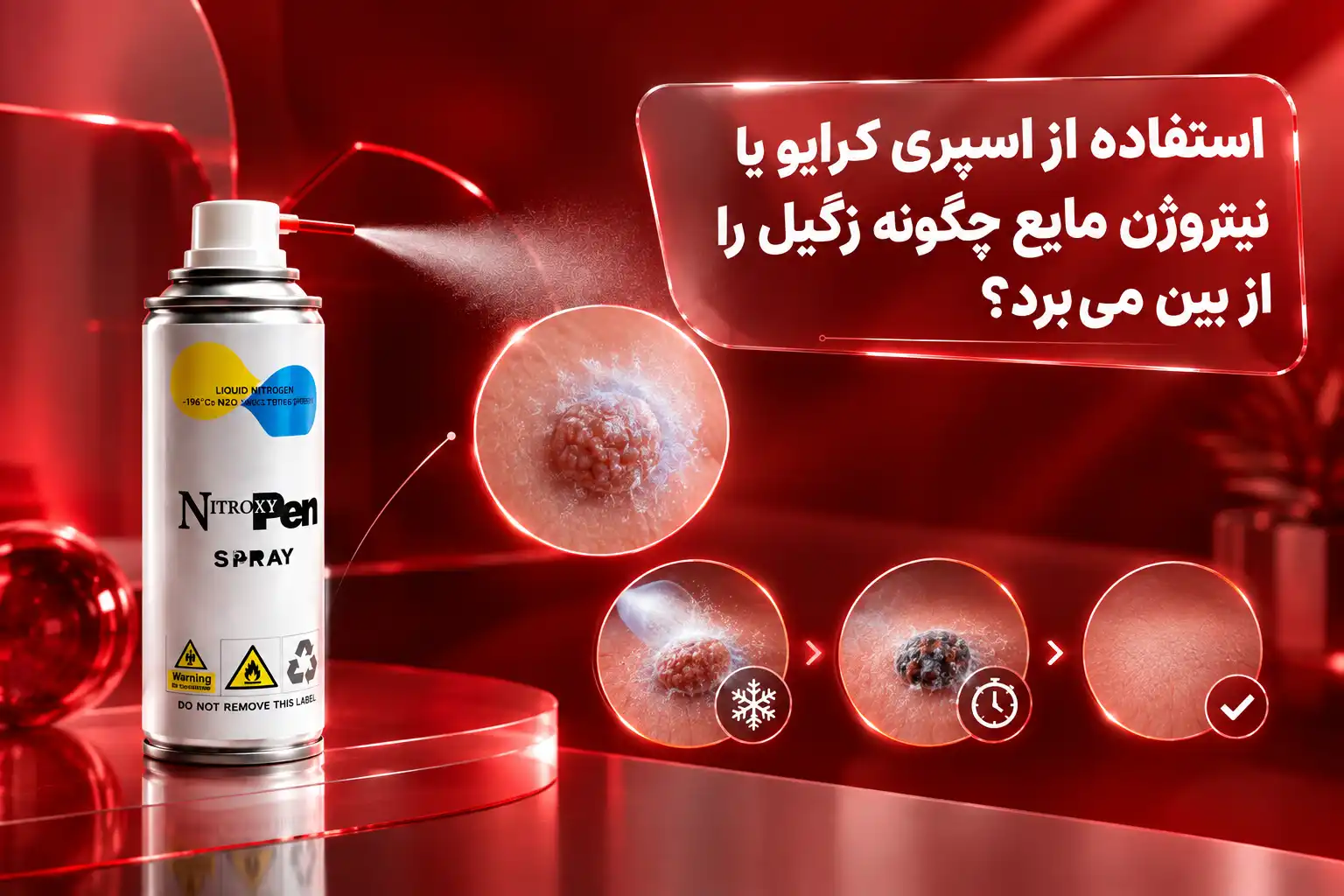 آیا هر زگیلی را می‌توان با اسپری کرایو درمان کرد؟